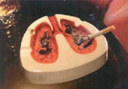 En Ölümcül Kanser Türü Akciğer Kanseri