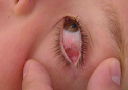 Bu da olur mu demeyin! Kene gözünün içini ısırdı