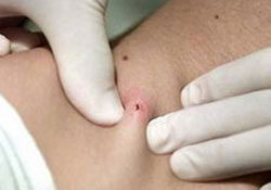 Samsunda 2 kişide daha KKKA şüphesi