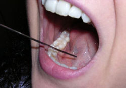 İri bademcik büyümeye engel oluyor