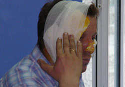 Çalıları yakmak isterken kendi yandı